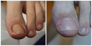 leczenie wrastających paznokci gorzów 2